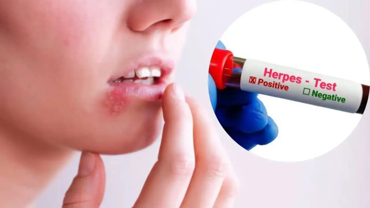 WHO Reports 3.8 Billion People Infected with Herpes Virus Worldwide